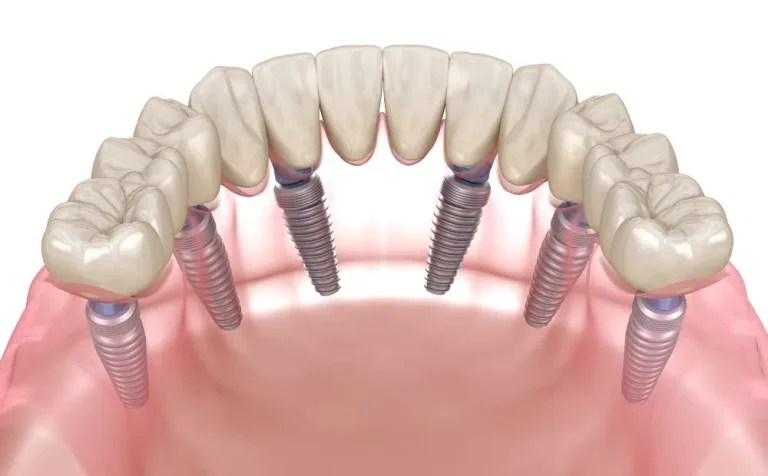 Understanding the Role of Dental Implants in Boosting Overall Wellbeing