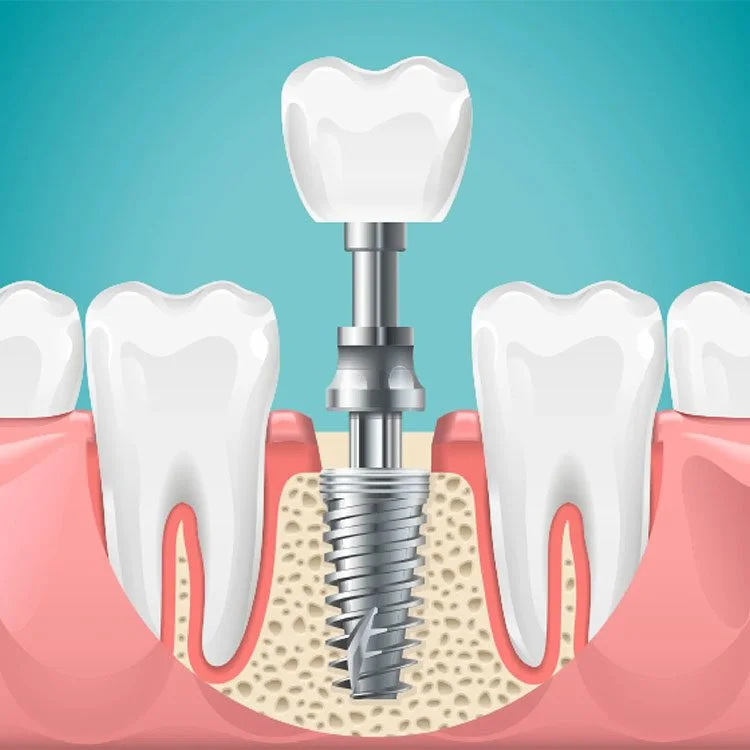 Understanding Bone Integration in Oral Implant Success