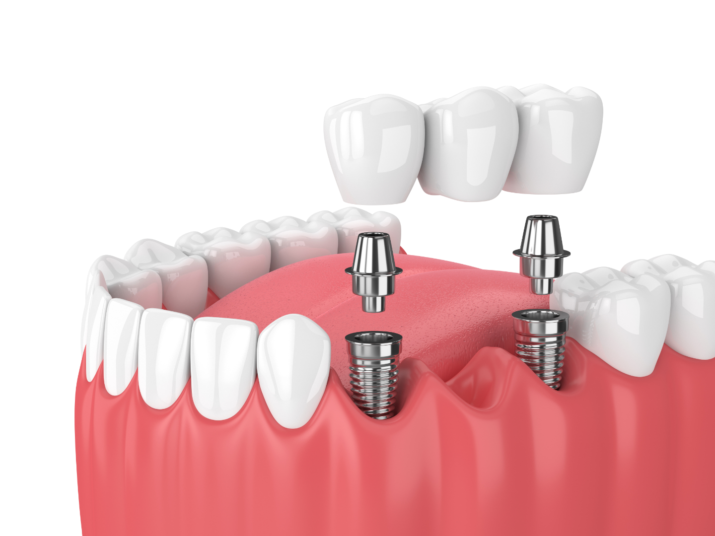 Navigating the Future of Dental Implants with Emerging Technologies